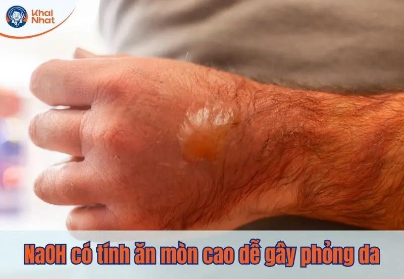 NaOH có tính ăn mòn da, khi tác dụng nước gây ra nhiệt độ cao gây phỏng da