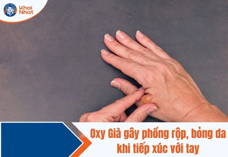 sử dụng oxy già không cẩn thận có thể làm bỏng da
